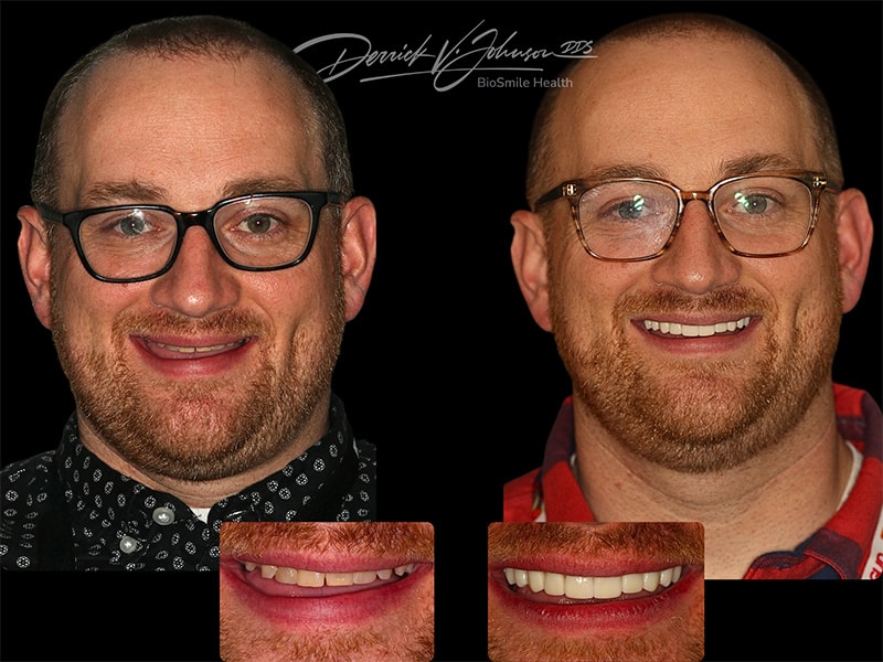 Copy of Before and After Case 11 TMJ