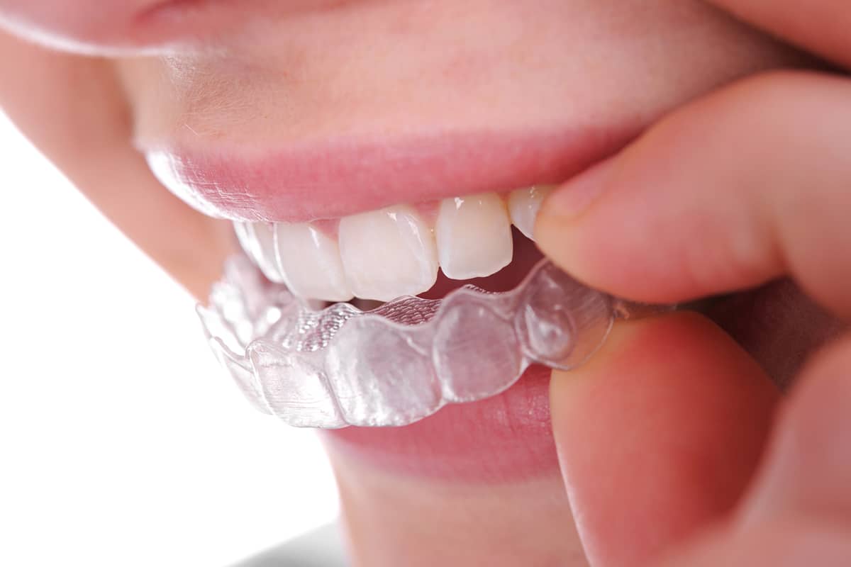 How long does it take for invisalign to work blog