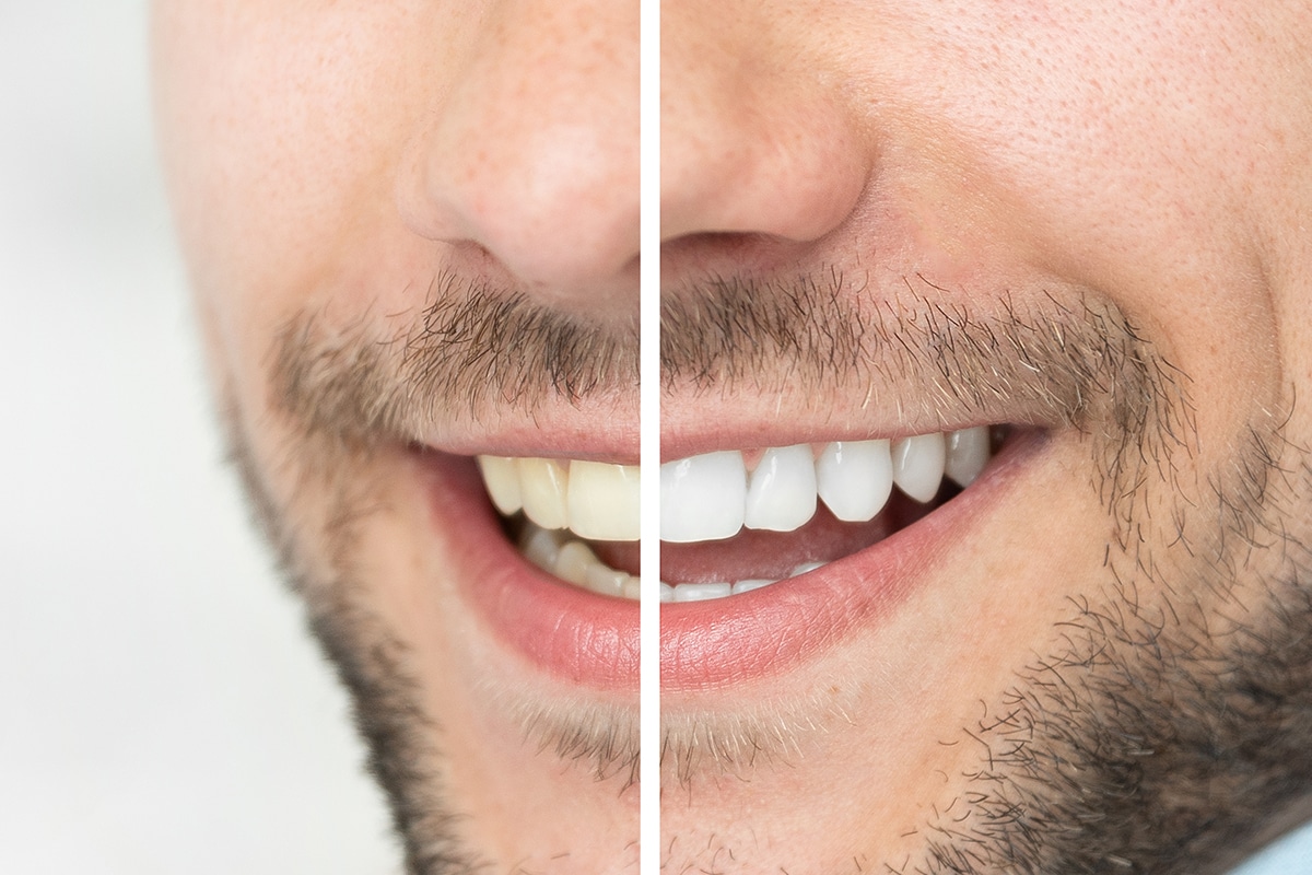 What is the cost of teeth whitening in bentonville ar blog